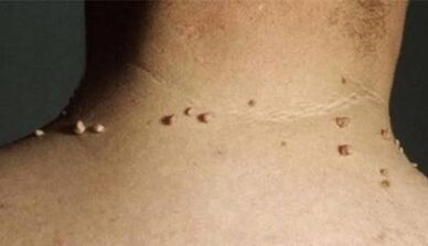 The reasons for the appearance of papillomas in the human body