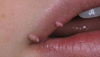 Types of papilloma in humans