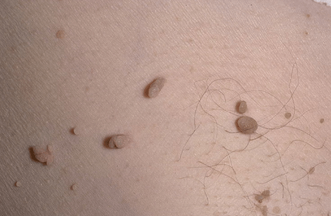 Papilloma