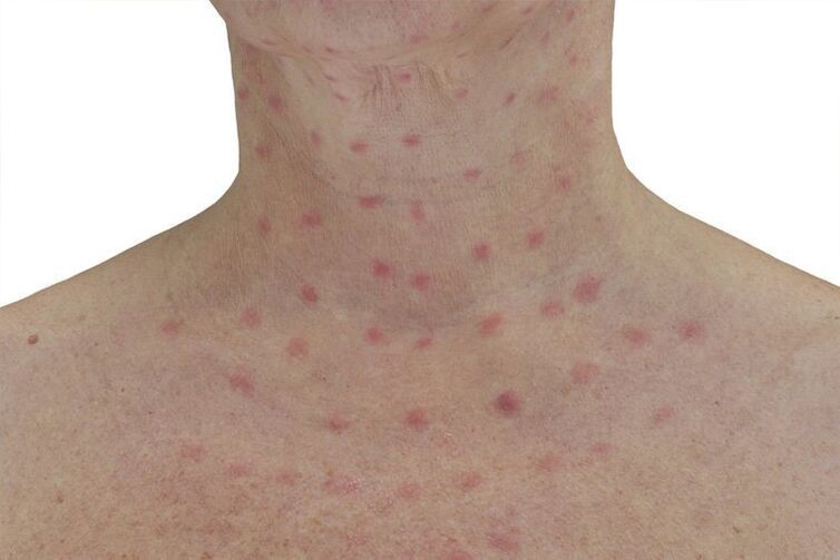 The skin after electrocoagulation