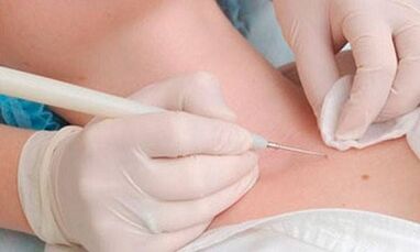 Papillomas elimination methods on the neck