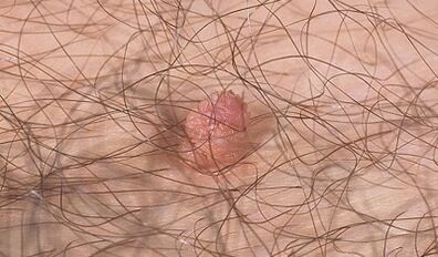 Ways to transfer human papillomavirus