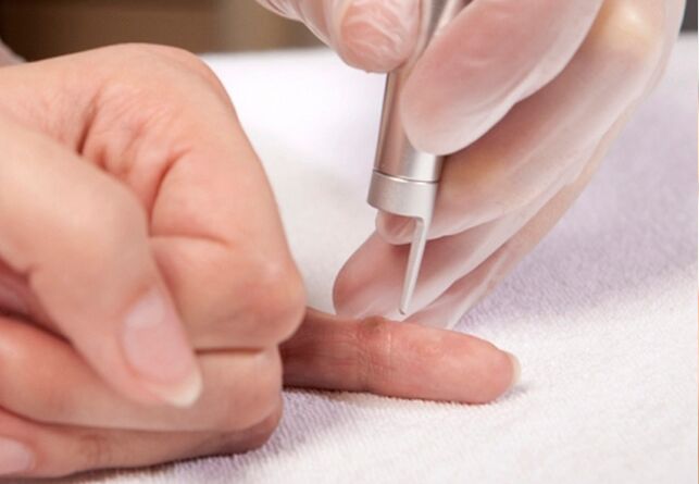 finger wart removal
