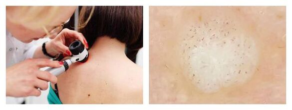 Dermatoscopy of the wart