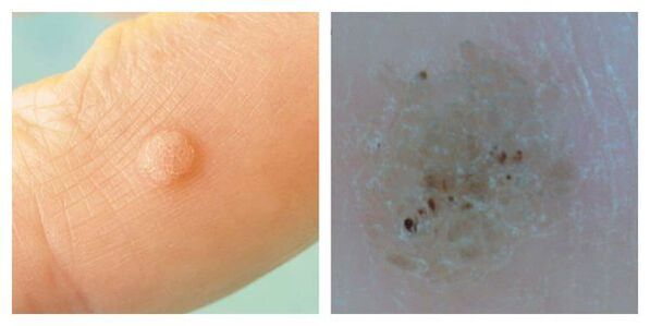 Ordinary wart during examination and dermatoscopy
