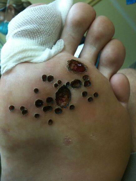 Skin after laser extraction of warts in the leg