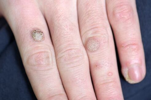WARTS IN THE ARM