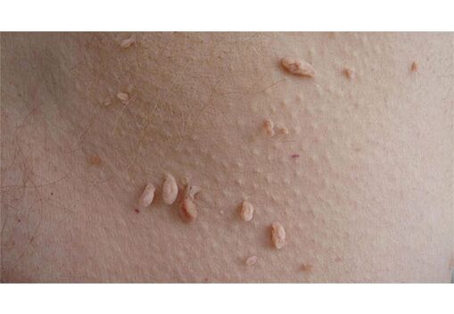 A sign of HPV infection is the appearance of papillomas on the body. 