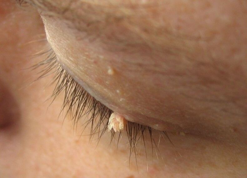 Warts in front of our eyes