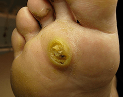 Subanary papillomas