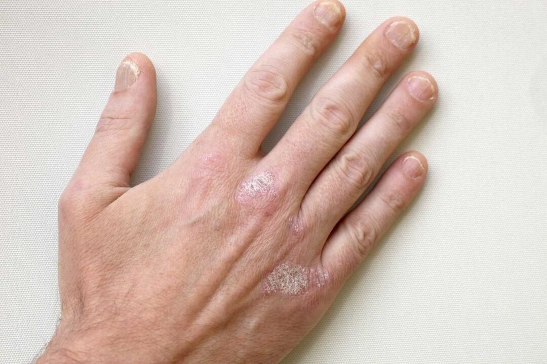 psoriasis on the hands of a man treated with Keramin cream